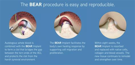 BEAR ACL Repair - Presidio Surgery Center