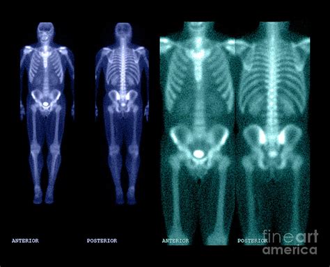 Bone Scan Photograph by Medical Body Scans - Pixels