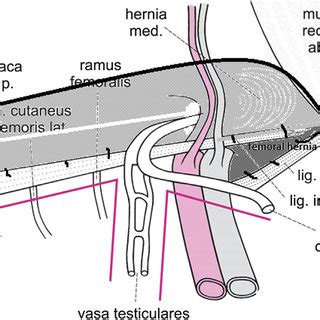 Cooper's Ligament Hernia