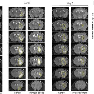 MRI images obtained on days 1, 3, and 5 after major hemorrhagic stroke... | Download Scientific ...