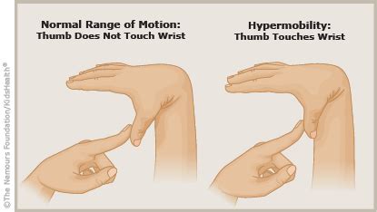 A to Z: Benign Joint Hypermobility Syndrome | Rady Children's Hospital