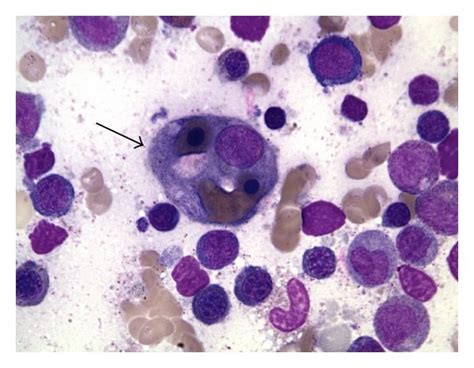 (a) Necrotizing granuloma evident on wedge-resected lung tissue. (b ...