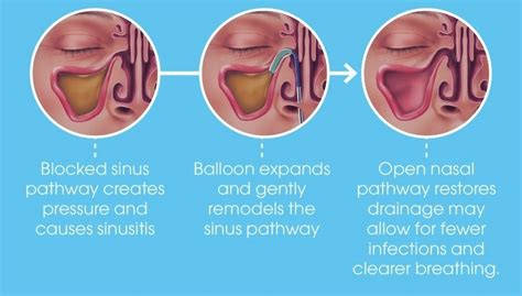 Balloon Sinus Dilation Boynton Beach FL - Sinus, Allergy, & Sleep