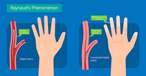 Raynaud Disease | The Surgical Clinic