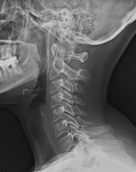 Normal Radiographic Anatomy of the Cervical Spine | Radiography, Radiology, Human body