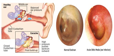 Signs of an Ear Infection | Health Life Media