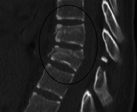 [Figure, Chance fracture Contributed by James...] - StatPearls - NCBI ...