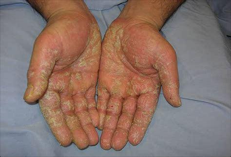 Treatment of Inherited Palmoplantar Keratoderma in Ayurveda - Dr ...