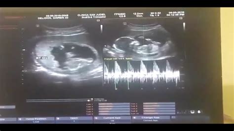 My 3 Months Ultrasound - YouTube