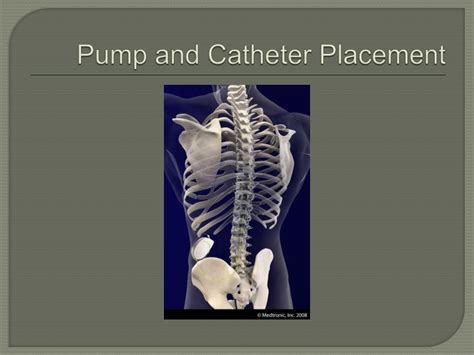 PPT - Intrathecal Baclofen Pump PowerPoint Presentation - ID:837111