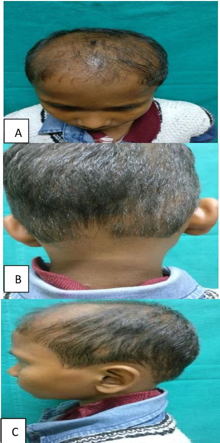 Figure 1 from Trachyonychia in a child with concomitant alopecia areata ...