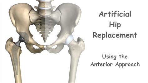 Artificial Hip Replacement - Anterior Approach - YouTube