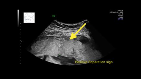 UOG videoclip: Separation sign: novel ultrasound sign for ruling out ...