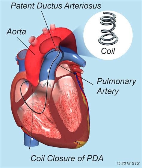 Patent Ductus Arteriosus | The Patient Guide to Heart, Lung, and Esophageal Surgery