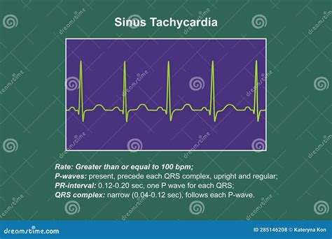 Electrocardiogram Displaying Sinus Tachycardia, 3D Illustration Stock Illustration ...