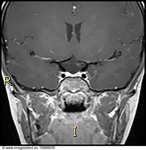 Small Pituitary and Ectopic Neurohypophysis Small Pituitary and Ectopic ...