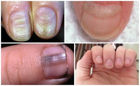 7 Serious Nail Conditions That Shouldn’t Be Ignored Because Of Their ...