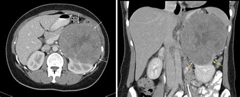 Renal Cell Carcinoma (2) - Radiology at St. Vincent's University Hospital