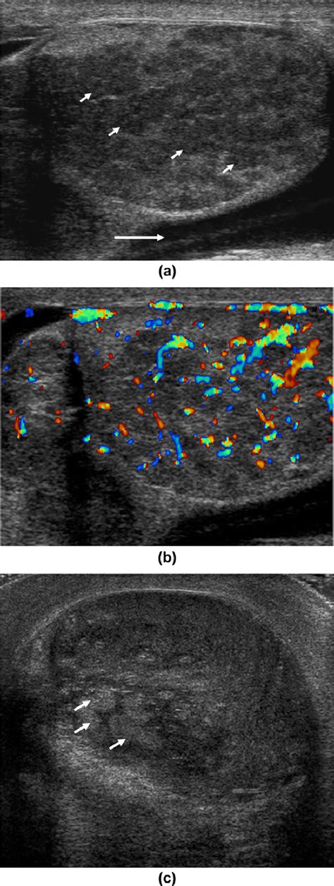 Orchitis. (a) A markedly abnormal testis with pockets of low ...