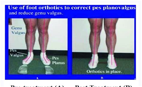 (A): Pes planovalgus, Pre-and (B): Post custom foot orthotics. disorder... | Download Scientific ...