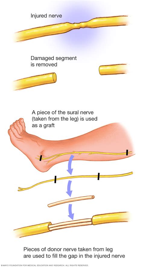 Peripheral nerve graft - Mayo Clinic