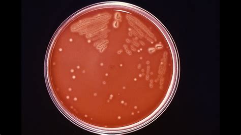 Flesh-eating bacteria Florida: Lee County, FL seeing 'abnormal ...