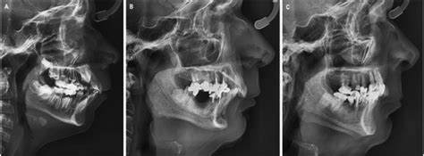 Novel genes linked to Class II Division 1 malocclusion with mandibular ...