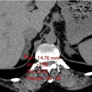 Adrenal lipid-rich adenoma with a negative mean density-suggestive for... | Download Scientific ...