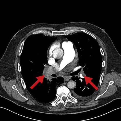 CT pulmonary angiography (CTPA) showinga bilateral pulmonary embolisms... | Download Scientific ...