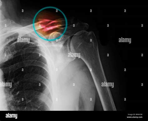 Clavicle Fracture Hi-res Stock Photography And Images Alamy, 47% OFF