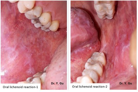 The Histopathological Difference Between Oral Lichen Planus and Oral ...