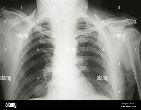 A chest x-ray of a patient with lung cancer showing a shadow on the ...