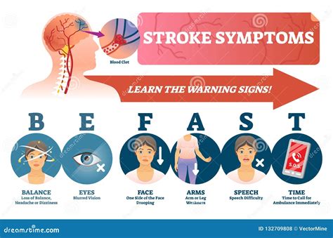 Stroke Symptoms Vector Illustration. Signs of Sudden Blood Clot in Head ...