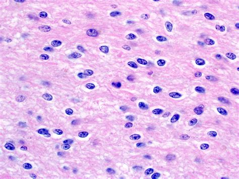 Pathology Outlines - Pilocytic astrocytoma