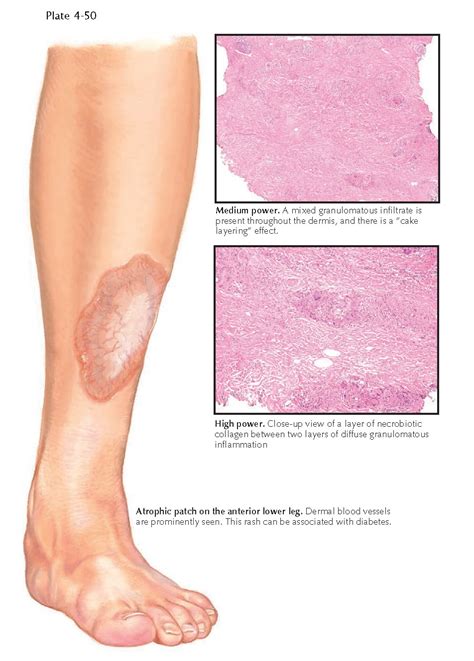 NECROBIOSIS LIPOIDICA - pediagenosis