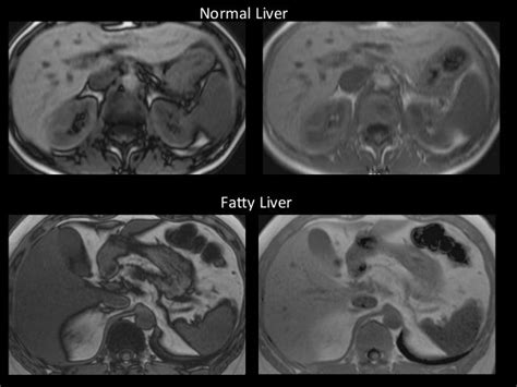 MR imaging of liver