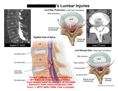 AMICUS Illustration of amicus,injury,lumbar,disc,protrusion,L4-5,nerve ...