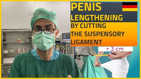 Penis lengthening: by cutting the suspensory ligament (+3) - YouTube