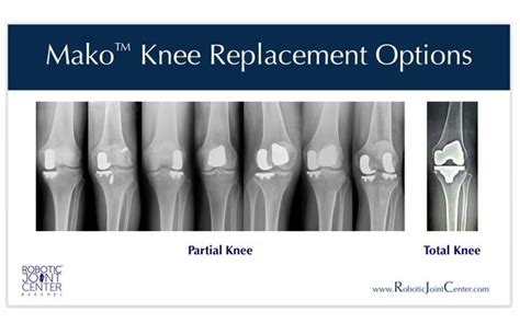 Partial & Total Knee Replacement: Frederick F. Buechel, Jr. MD: Stryker's Mako™ Robotic Knee ...