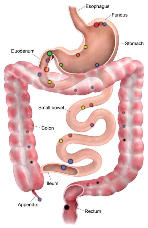 Gastroenteropancreatic neuroendocrine tumors | Oncohema Key