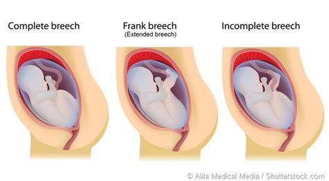 Extended Breech, Flexed Breech and Footling Breech