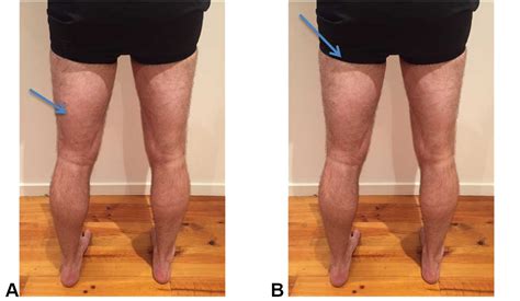 Hamstring Injury Management & Prevention - South Coast Physiotherapy