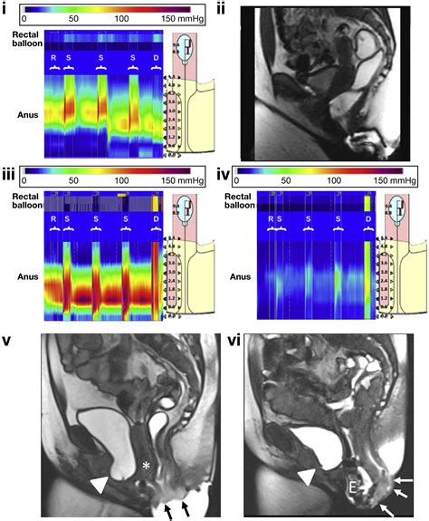 High-resolution Anorectal Manometry for Identifying Defecatory Disorders and Rectal Structural ...