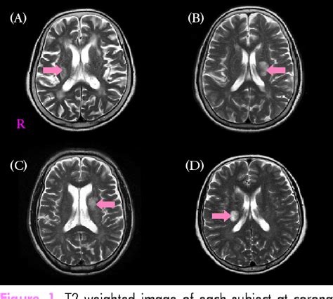 [PDF] Motor Function Recovery in Stroke Patients with Corona Radiata Infarct: 4 Case Studies ...