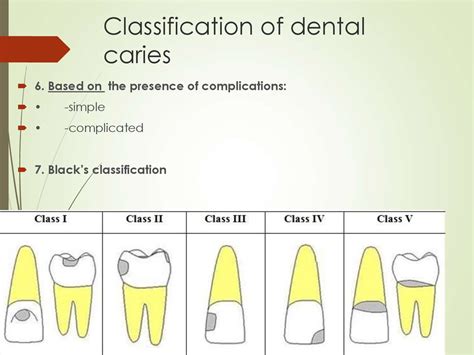 Classification Of Dental Caries Classification Of Dental Caries The | The Best Porn Website