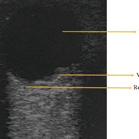 Normal eye. VC: Vitreous chamber. | Download Scientific Diagram