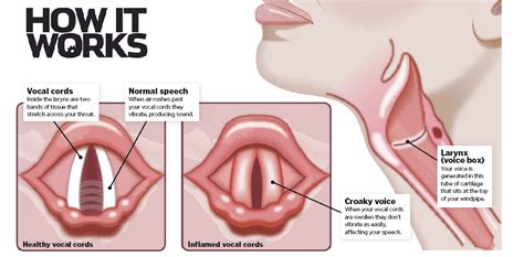 Why do we lose our voice? – How It Works | Science and technology ...