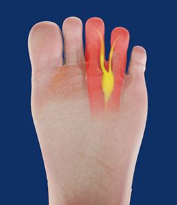 Morton’s Neuroma Sydney, NSW | Foot Pain & Surgery Randwick