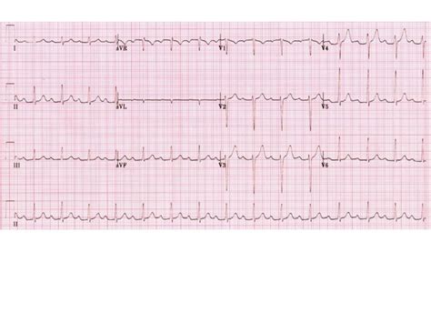 ECG Lecture: Sinus arrest, sinoatrial exit block, AV block and escape…