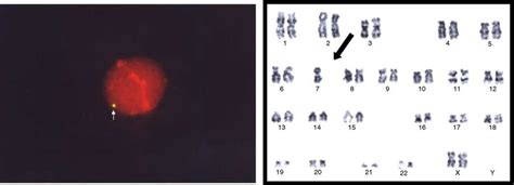 Monosomy 7 clone in the bone marrow FISH and chromosome analysis of the ...